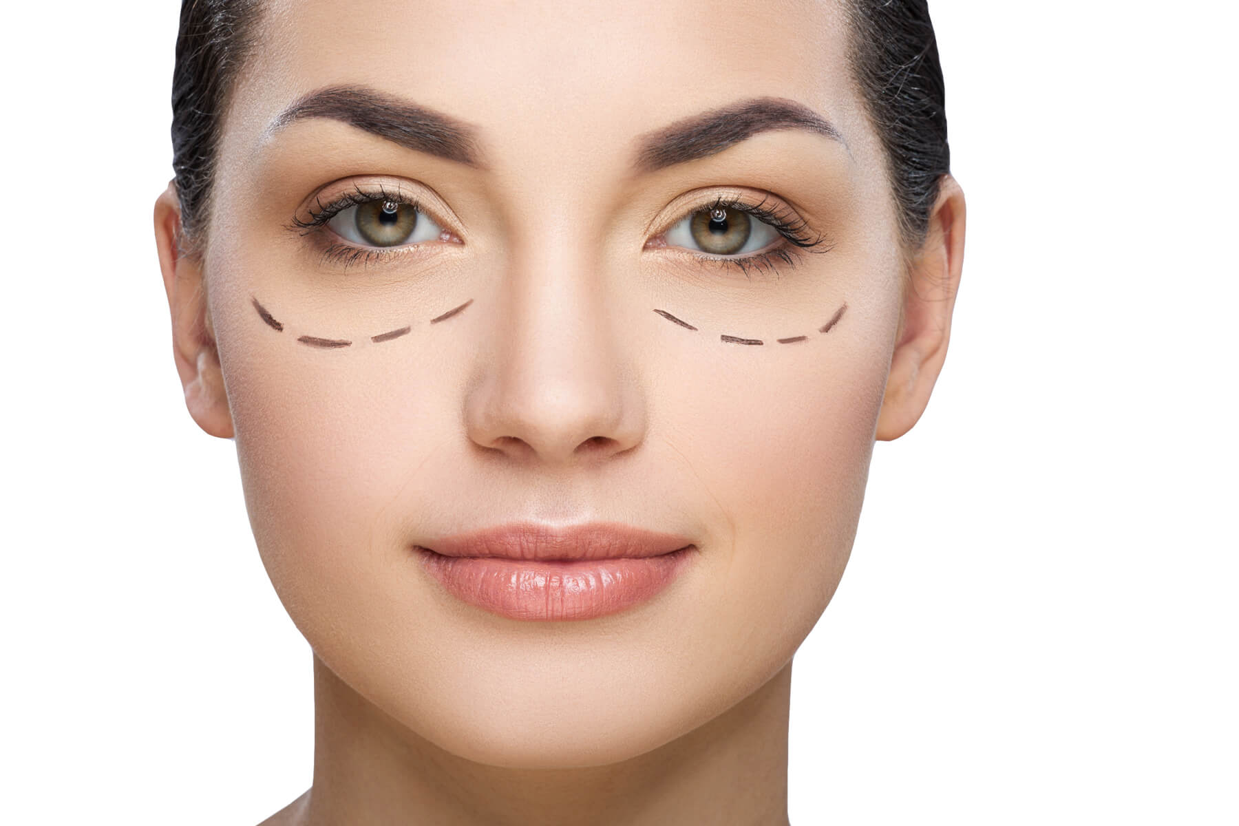 blefaroplastia