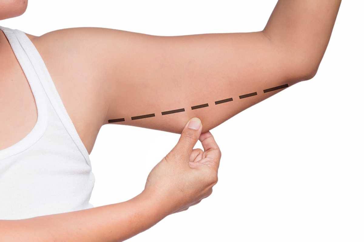 braquioplastia